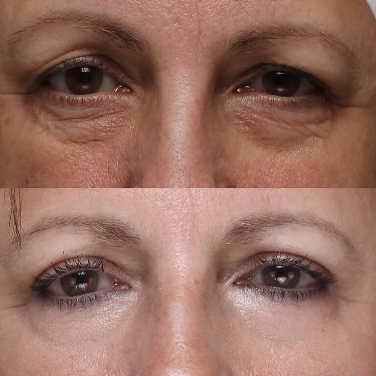21+moy+md+before+after+Upper+Eyelid+Bleph+Lower+Eye+CO2
