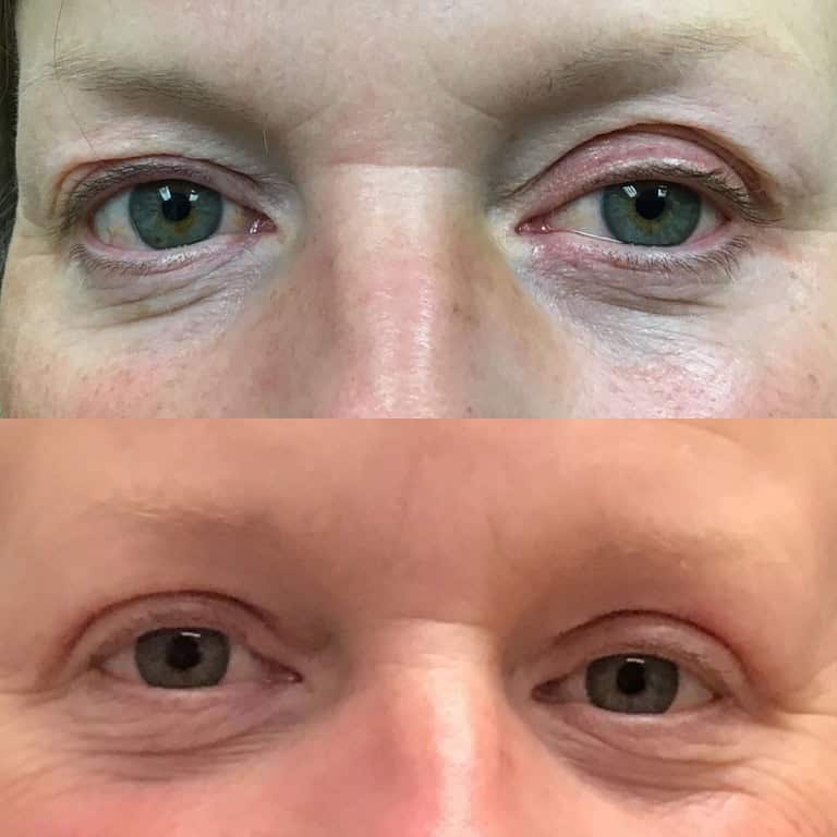 25+moy+md+before+after+Upper+Eyelid+Blepharoplasty
