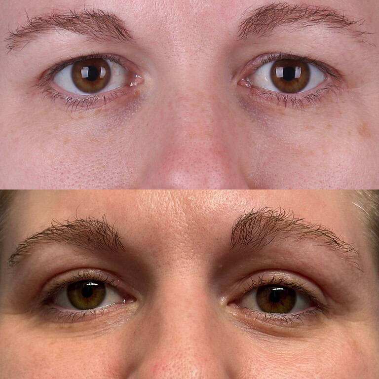 26+moy+md+before+after+Upper+Blepharoplasty