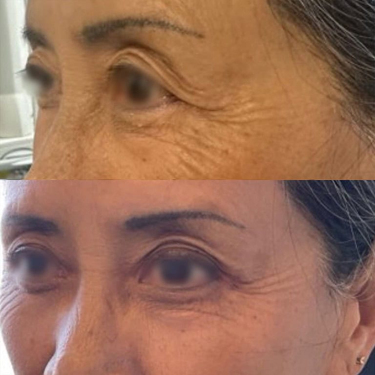 29+moy+md+before+after+Upper+Eye+Blepharoplasty+01