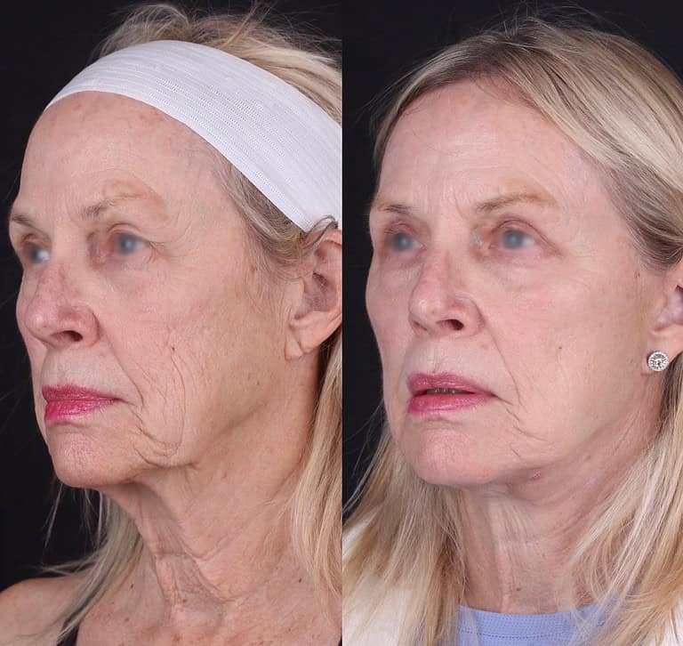 3+moy+md+before+after+Facelift+Upper+Bleph+CO2+2