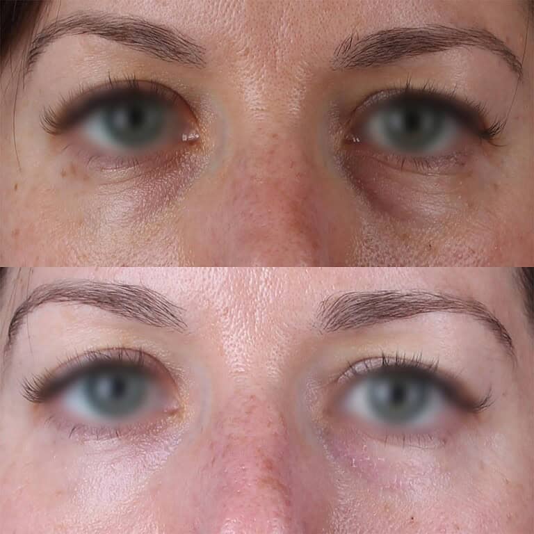 40+moy+md+before+after+Under-Eye+CO2+Laser