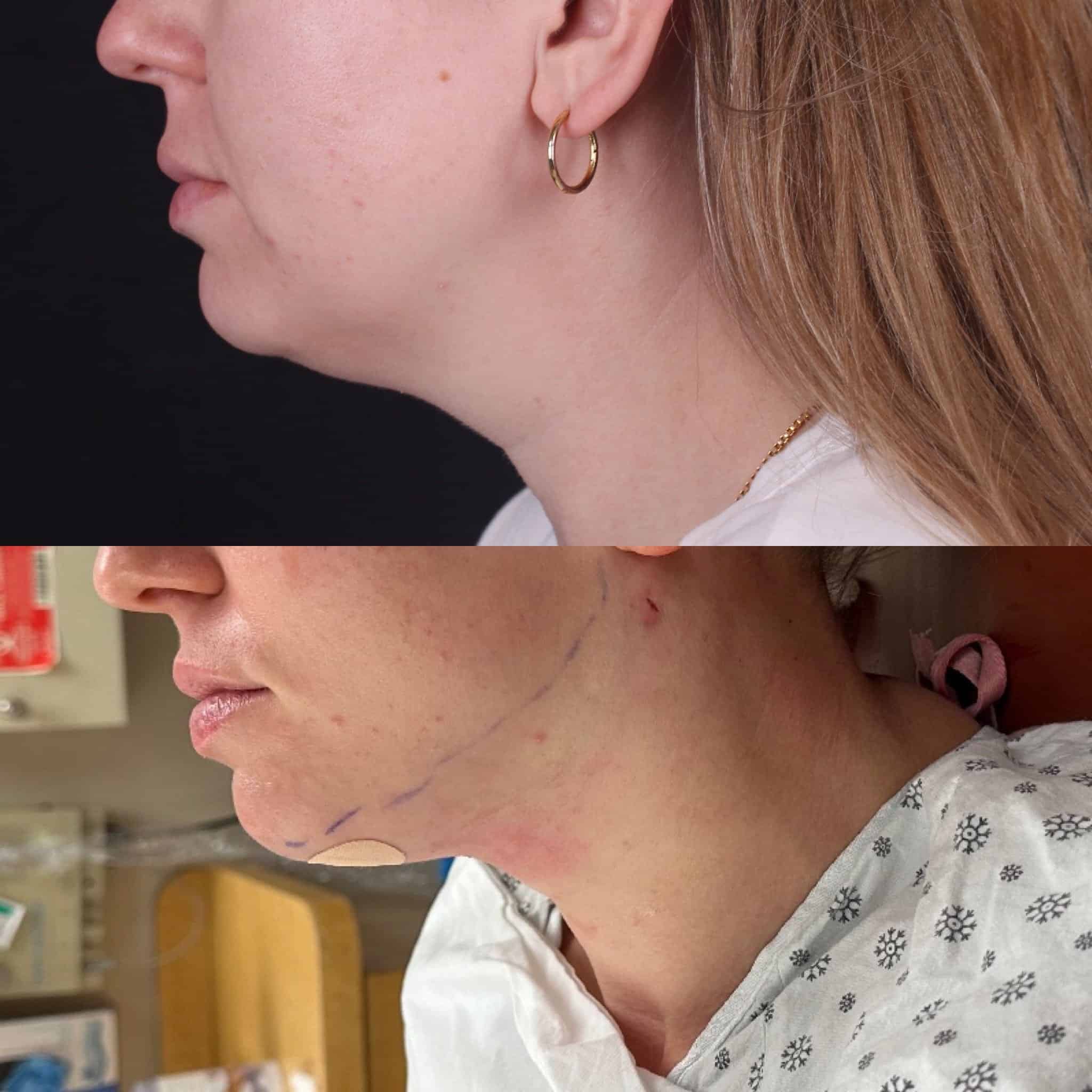 46+moy+md+before+after+AccuTite+Submental+Lipo+01