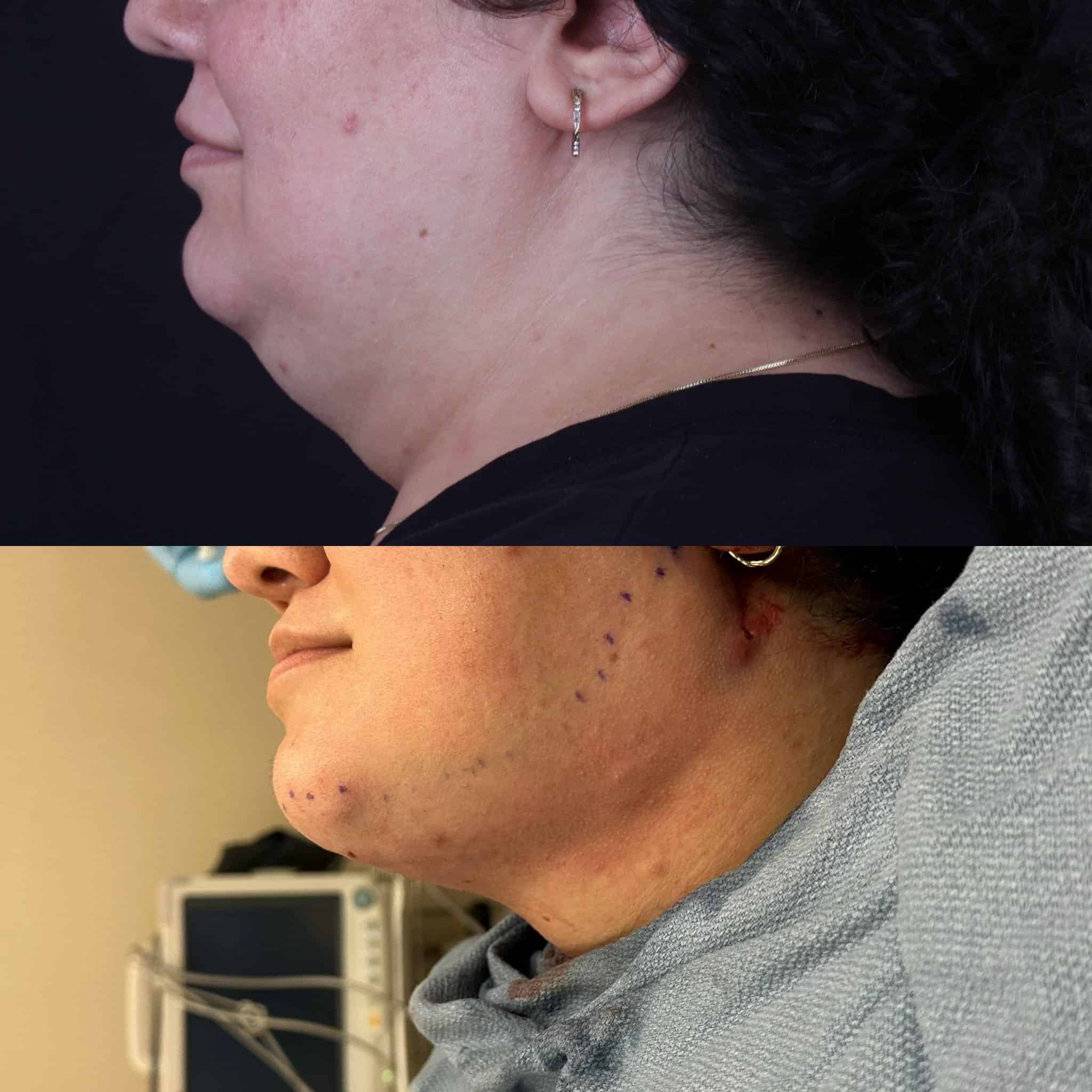 49+moy+md+before+after+Submental+Liposuction+and+Facetite+02
