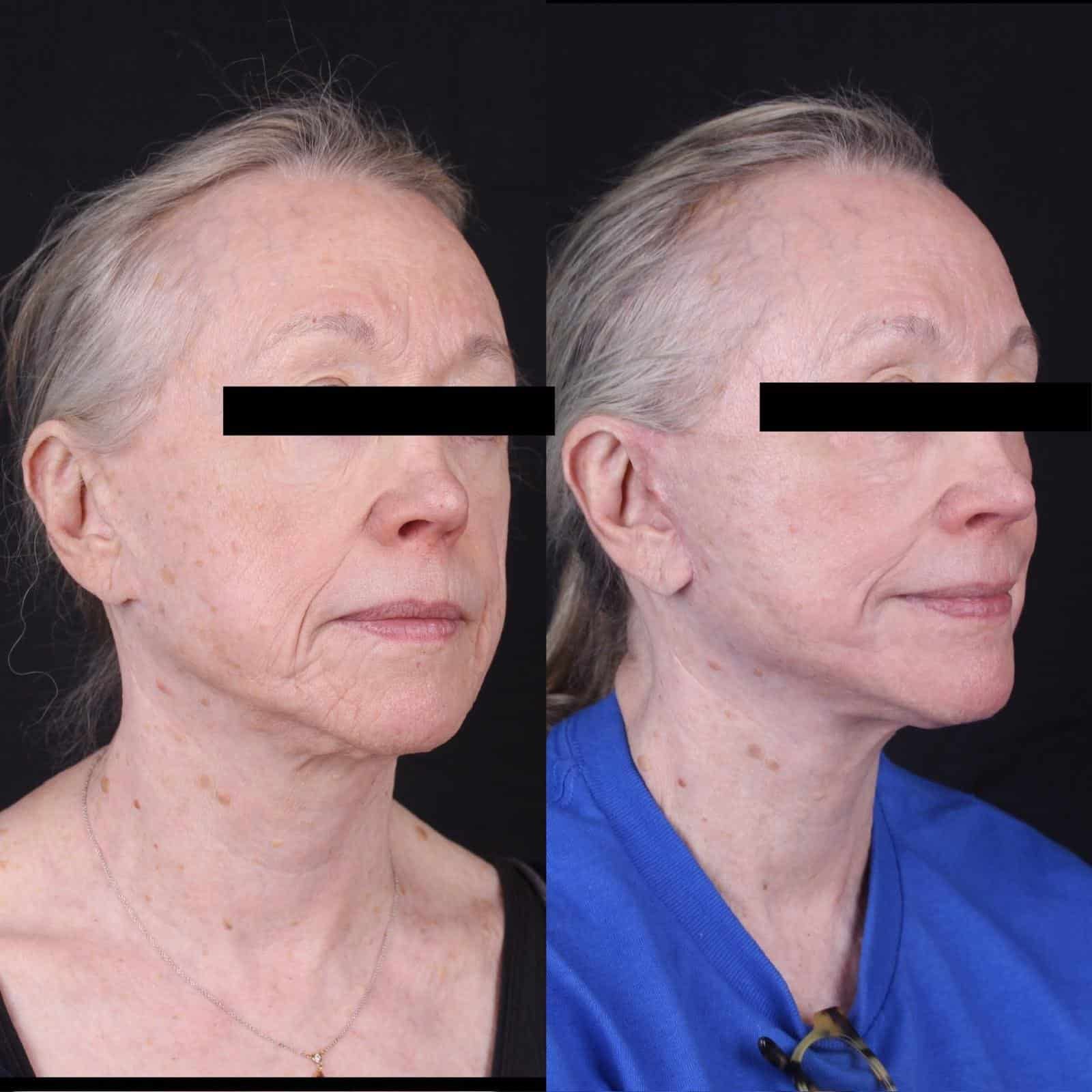 4+moy+md+before+after+Facelift+Neck+Lift+CO2