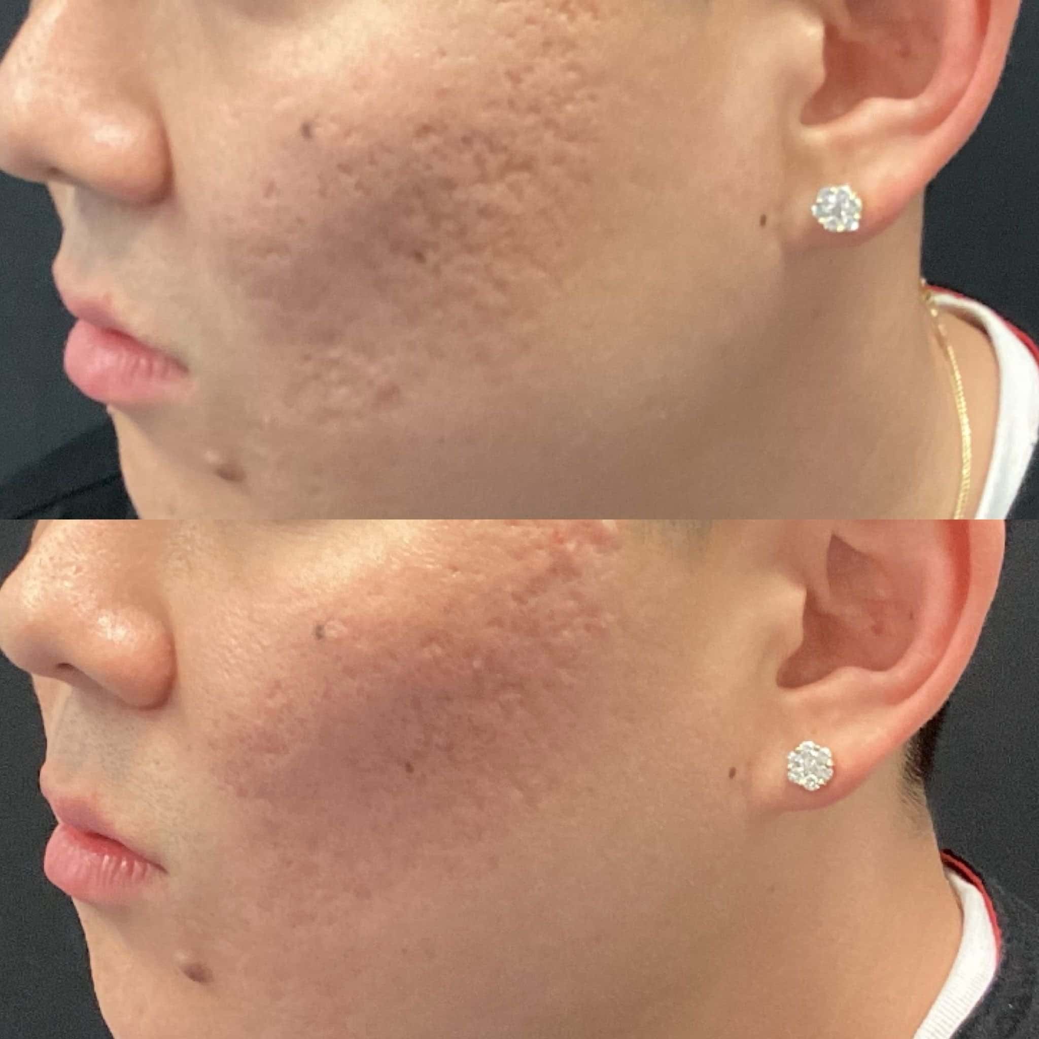 50+moy+md+before+after+CO2+Laser+Acne+Scarring