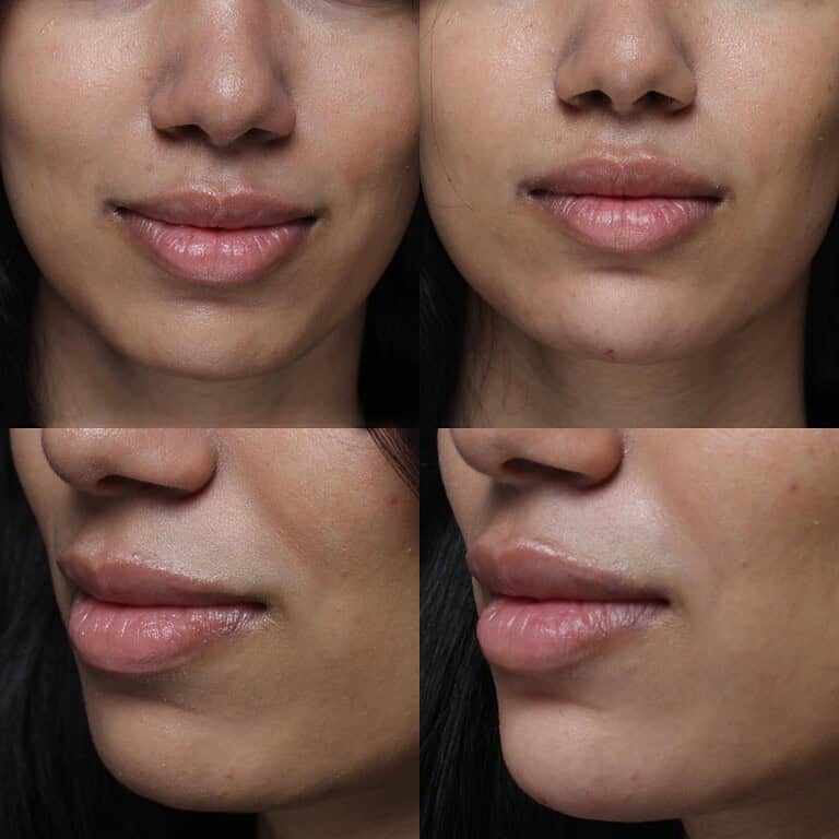 52+moy+md+before+after+chin+filler