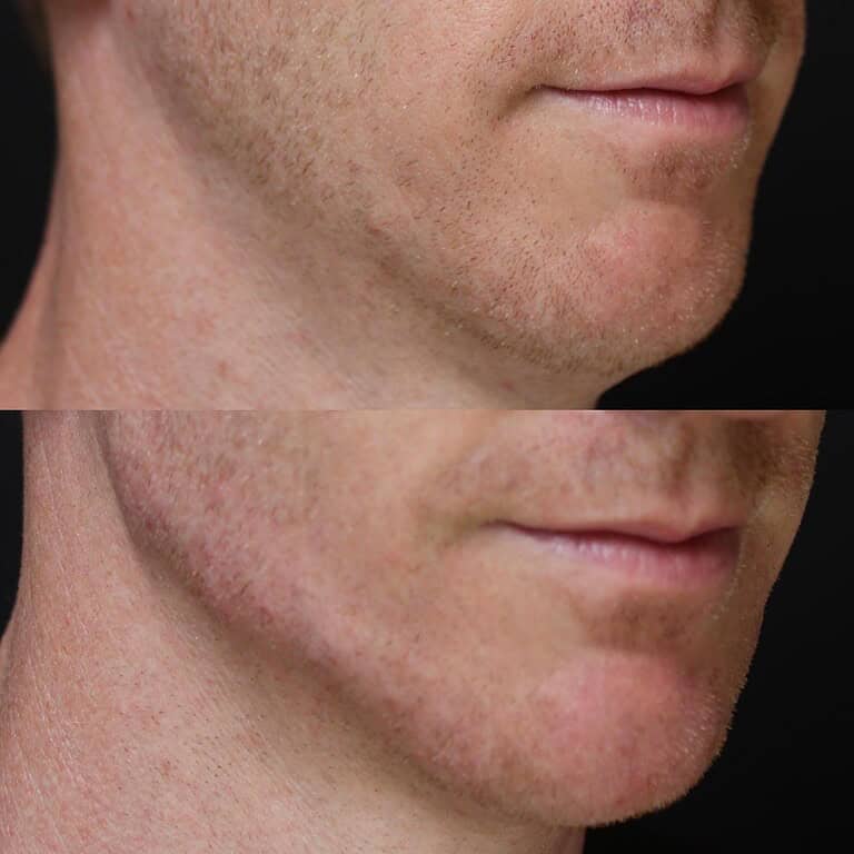 53+moy+md+before+after+jawline+filler