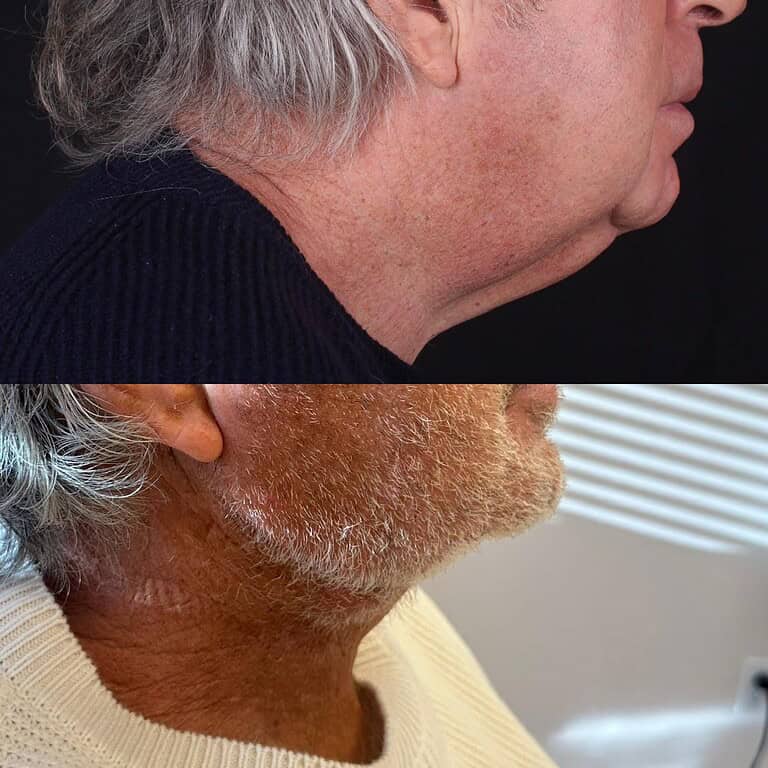 6+moy+md+before+after+Minimally+Invasive+Hidden+Scar+Neck+Lift+01