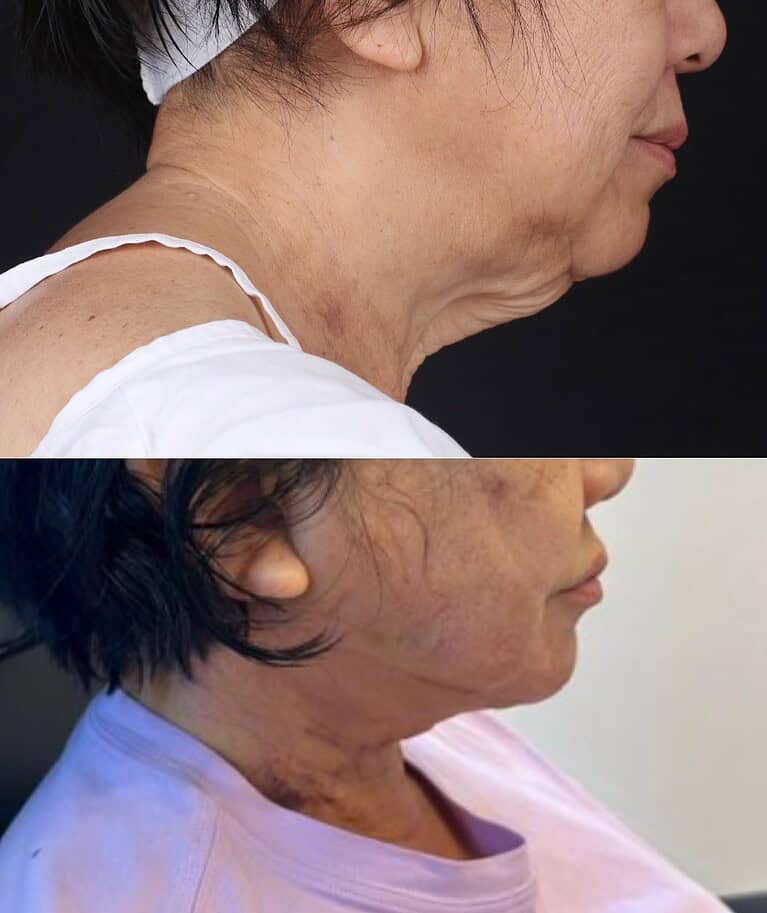7+moy+md+before+after+Minimally+Invasive+Hidden+Scar+Neck+Lift